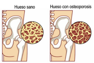 Hueso sano y con osteoperosis