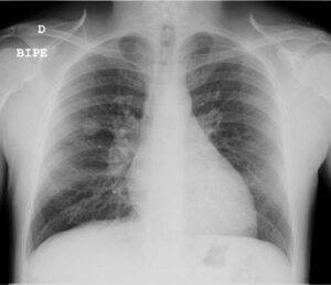 Radiografía de tórax (2)